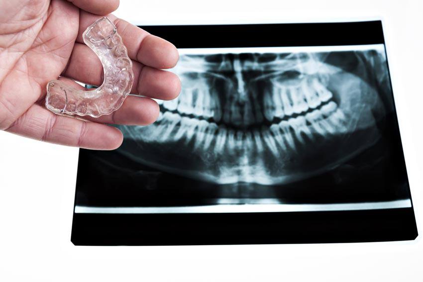 Hand holding a mouthguard next to a mouth xray