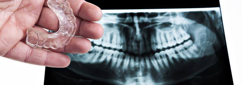 Hand holding a mouthguard next to a mouth xray